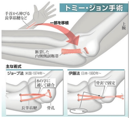 トミー ジョーンズ 手術