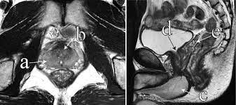 mri で ガドリニウム 造影 剤 を 使用 する 際 に 最も 注意 す べき 患者 背景 は どれ か
