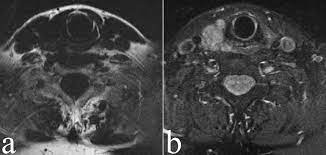 mri で ガドリニウム 造影 剤 を 使用 する 際 に 最も 注意 す べき 患者 背景 は どれ か
