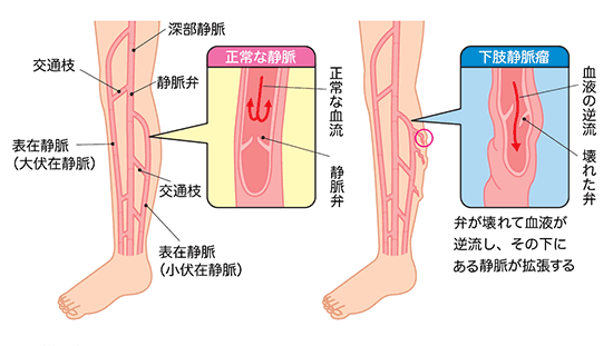 初期 症状 として 下肢 の 浮腫 が 特徴 的 なのは どれ か