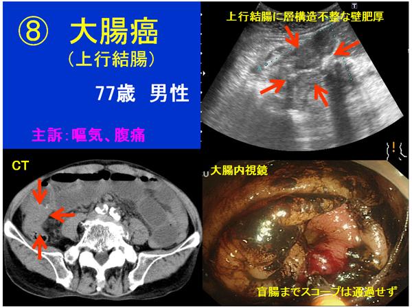 腹部 エコー みぞおち 何 度 も