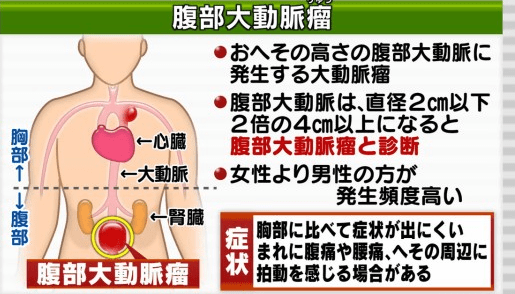 腹部 大動脈 瘤 セルフ チェック